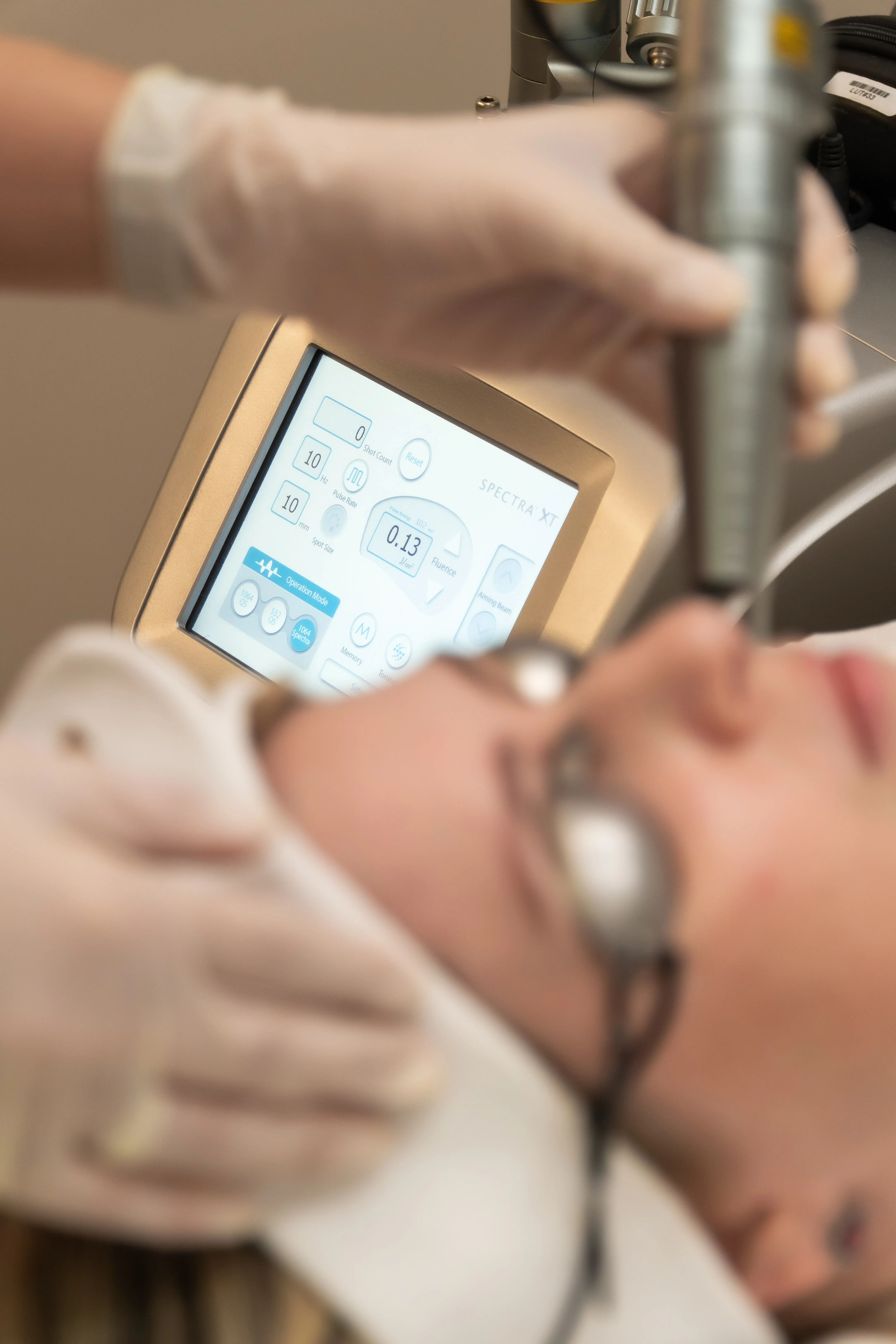 Tecnologia Laser Spectra XT - Tratamento para manchas, melasma e qualidade da pele.